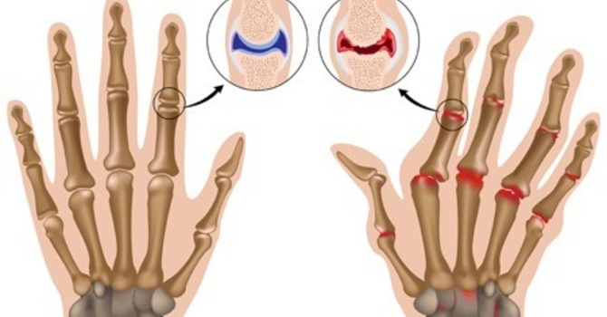Rheumatoid Arthritis-Natural Support for Joint Pain image