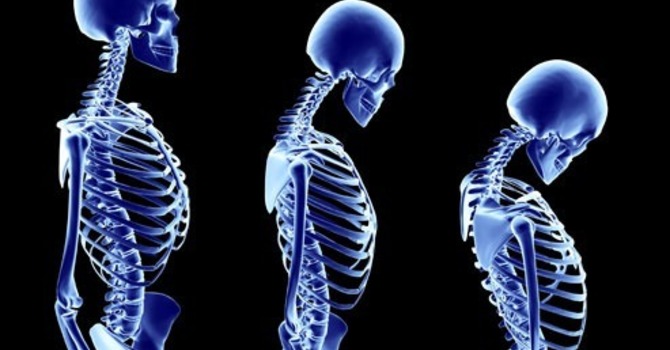 Reverse Osteoporosis Now Part 1