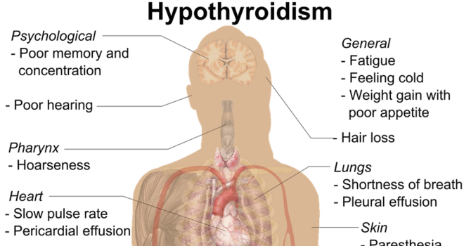 Hypothyroidism – The Hidden Epidemic Part 2