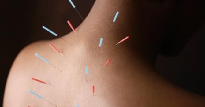 Acupuncture Treatment For Arthritis Pain Part 2