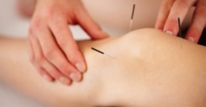 Acupuncture Treatment For Arthritis Pain Part 1