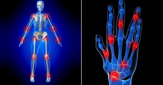 Arthritis – Natural Support for Joint Pain Part 1 image